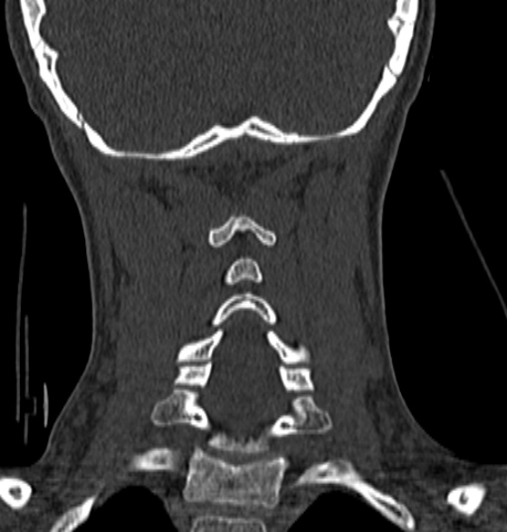File:Normal CT cervical spine - 12-year-old (Radiopaedia 55352-61775 Coronal bone window 153).jpg