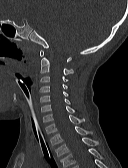 File:Normal CT cervical spine - pediatric (Radiopaedia 52549-58462 Sagittal bone window 90).jpg