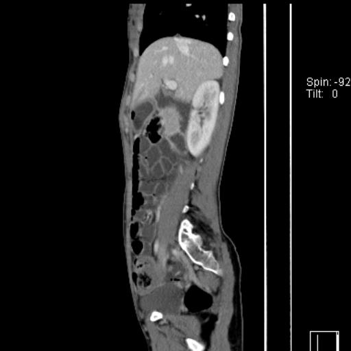 Normal CT enterography (Radiopaedia 30357-31000 D 37).jpg