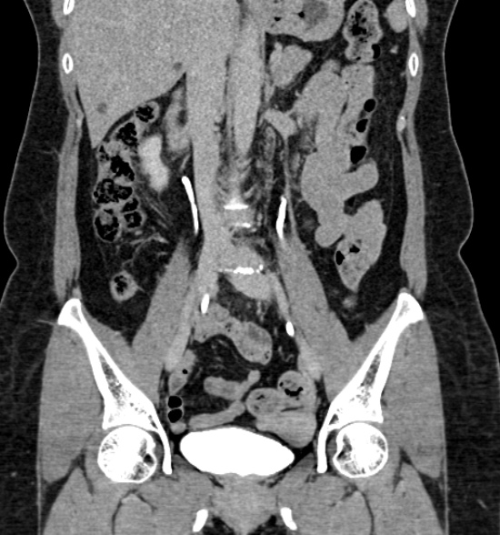 Normal CT intravenous urogram (Radiopaedia 39444-41759 A 267).jpg
