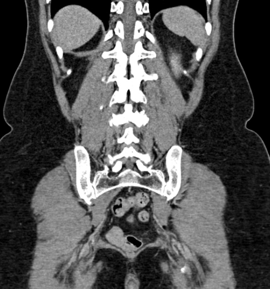 Normal CT intravenous urogram (Radiopaedia 39444-41759 A 346).jpg
