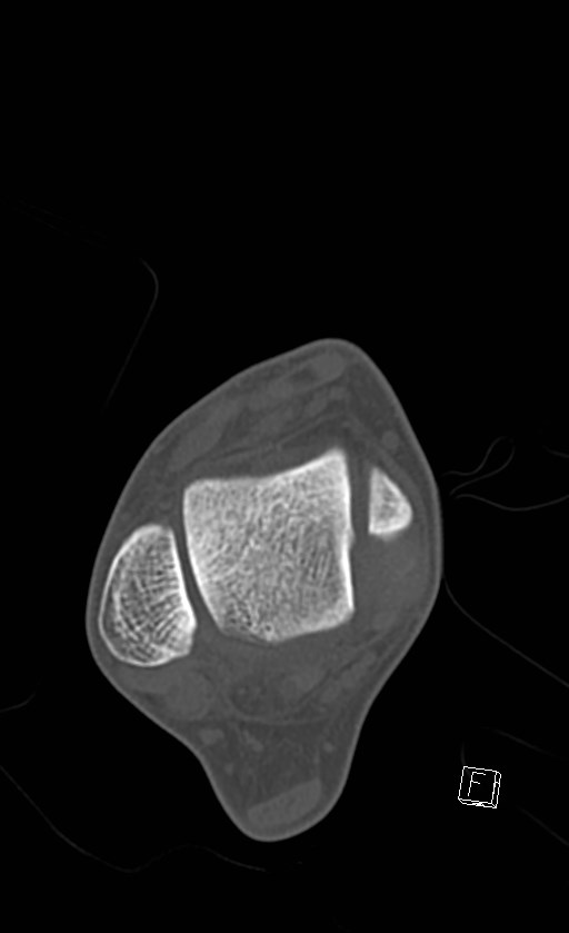 Normal CT of the ankle (Radiopaedia 47111-51658 Axial bone window 43).jpg