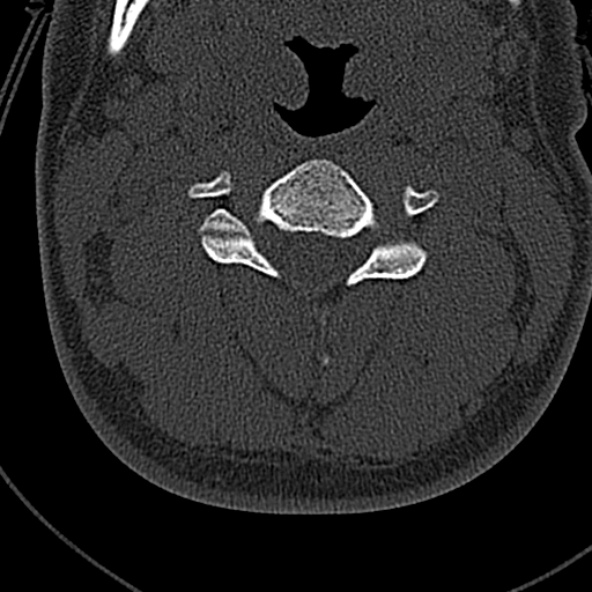 Normal CT of the cervical spine (Radiopaedia 53322-59305 Axial bone window 114).jpg