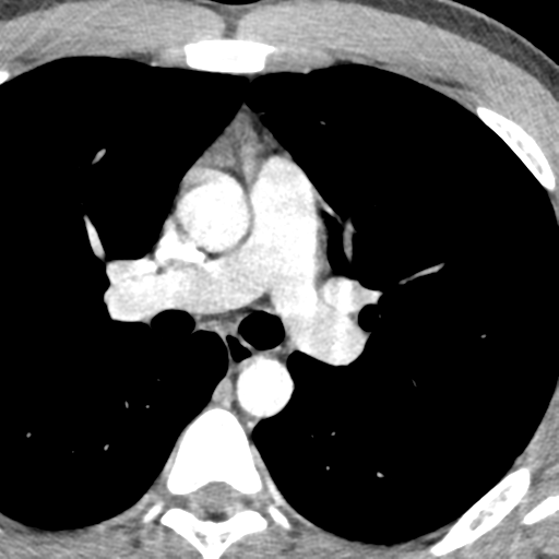 File:Normal CT pulmonary veins (pre RF ablation) (Radiopaedia 41748-44702 A 72).png