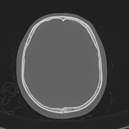 Normal CT skull (Radiopaedia 40798-43459 A 112).png