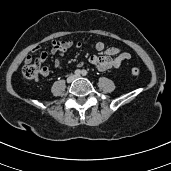 File:Normal CT split bolus study of the renal tract (Radiopaedia 48631-53634 Axial split bolus 171).jpg