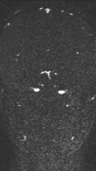 Normal MRI brain with MRV- teenager (Radiopaedia 49425-54553 Coronal MRV 128).jpg
