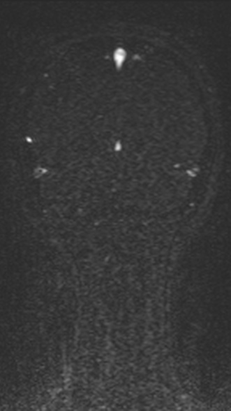 Normal MRI brain with MRV- teenager (Radiopaedia 49425-54553 Coronal MRV 196).jpg