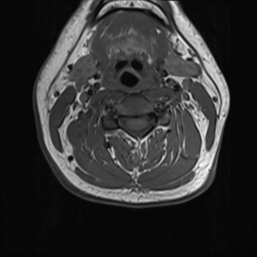 File:Normal MRI cervical spine (infection protocol) (Radiopaedia 53916-60039 Axial 23).png