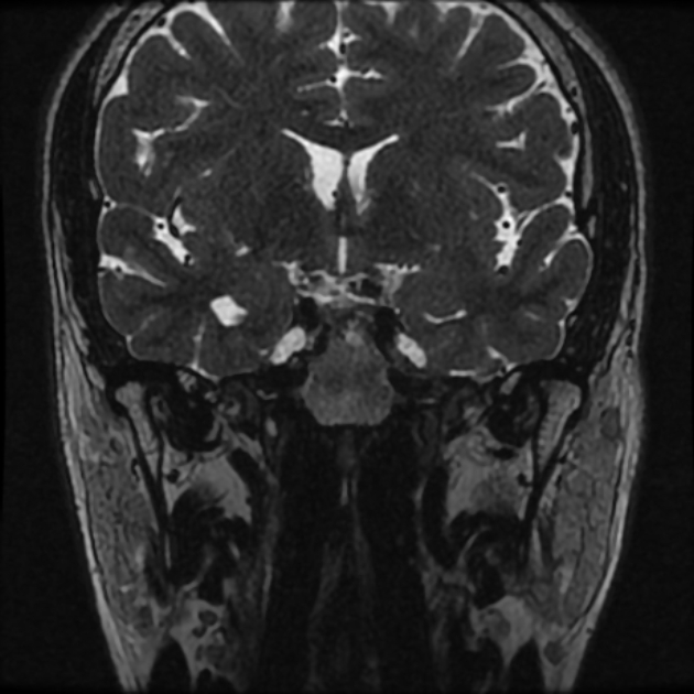 Normal MRI petrous (Radiopaedia 91317-108949 Coronal T2 12).jpg