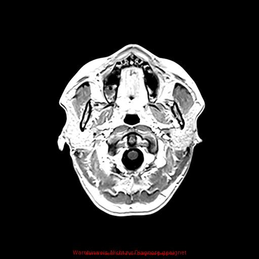 Normal adult brain MRI (non-enhanced and contrast-enhanced) (Radiopaedia 75262-86379 Axial T1 C+ 36).jpg