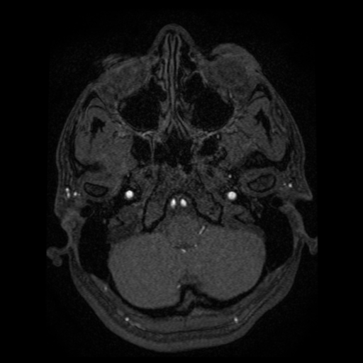Normal brain MRA (Radiopaedia 41046-43793 Axial MRA 106).png
