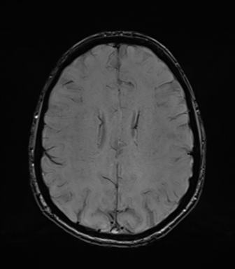 Normal brain MRI (TLE protocol) (Radiopaedia 40748-43405 Axial SWI 57).png