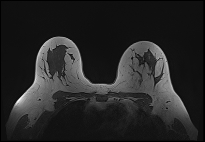 File:Normal breast MRI - dense breasts (Radiopaedia 80454-93850 Axial T1 147).jpg