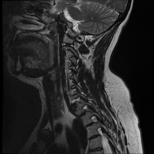 File:Normal cervical and thoracic spine MRI (Radiopaedia 35630-37156 Sagittal T2 10).png