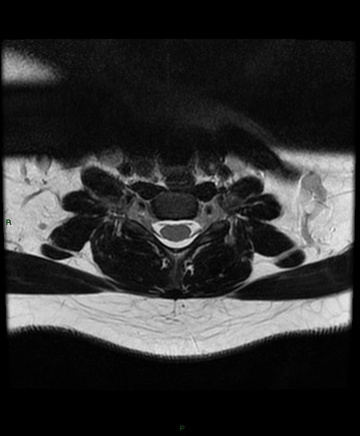 Normal cervical spine MRI (Radiopaedia 80146-93454 Axial T2 71).jpg