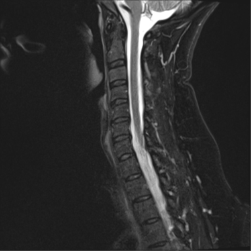 File:Normal cervical spine MRI (including Dixon) (Radiopaedia 42762-45925 Dixon- Water 7).png