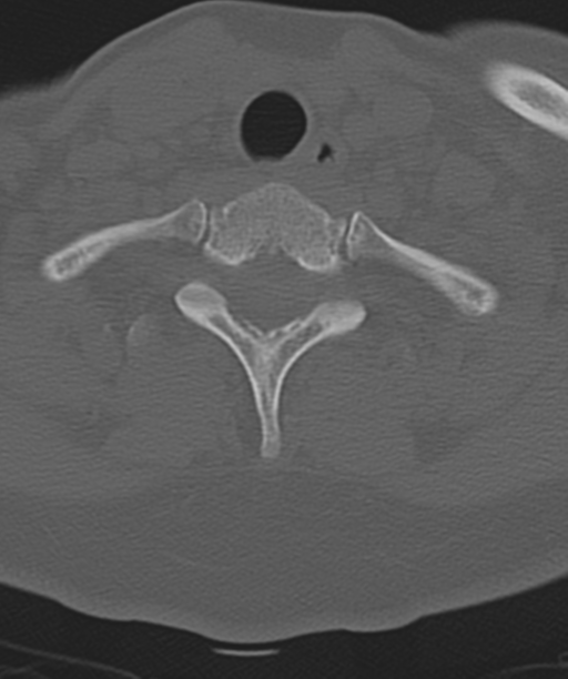 Normal cervical spine MRI (including Dixon) (Radiopaedia 42762-45926 Axial bone window 50).png