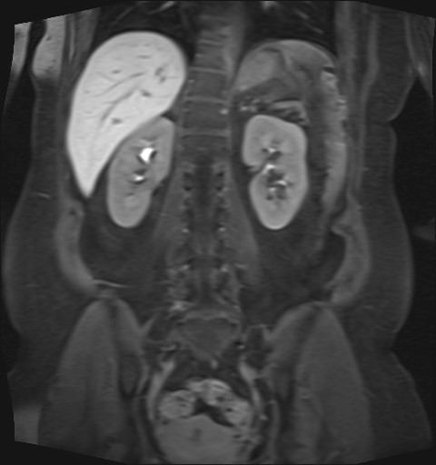 File:Normal hepatobiliary phase liver MRI (Radiopaedia 58968-66230 B 16).jpg