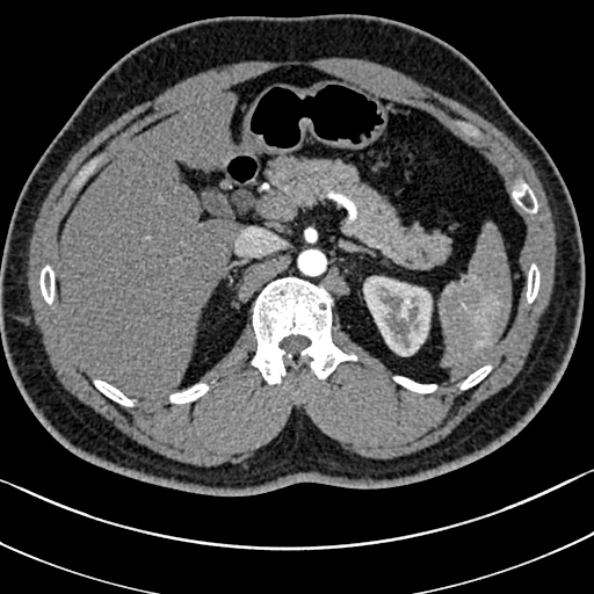 Normal kidneys on 4-phase CT study (Radiopaedia 25889-26038 B 12).jpg