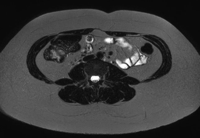 File:Normal liver MRI with Gadolinium (Radiopaedia 58913-66163 E 1).jpg