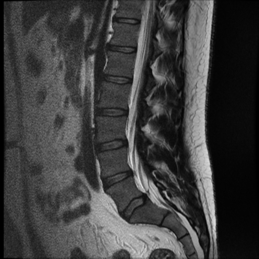 File:Normal lumbar spine MRI (Radiopaedia 35543-37039 Sagittal T2 8).png