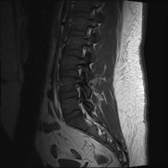 File:Normal lumbar spine MRI (Radiopaedia 47857-52609 Sagittal T1 6).jpg