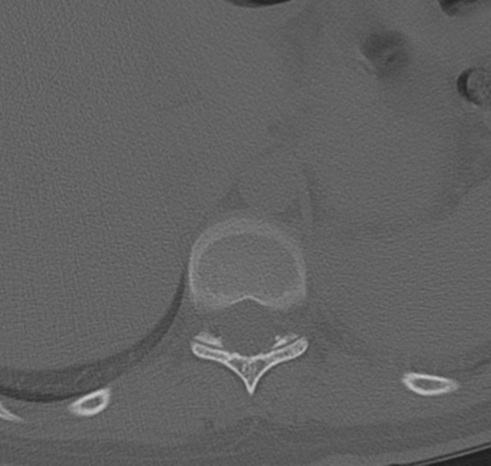 File:Normal lumbosacral CT (Radiopaedia 37923-39867 Axial bone window 6).png