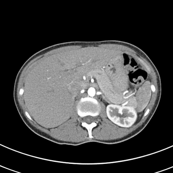 File:Normal multiphase CT liver (Radiopaedia 38026-39996 B 22).jpg