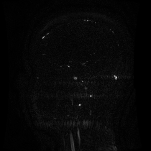 Normal noncontrast MR venography (Radiopaedia 87578-103957 A 109).jpg