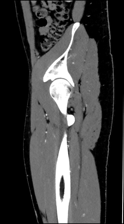 Normal pelvis CT angiogram (Radiopaedia 84966-100481 C 86).jpg
