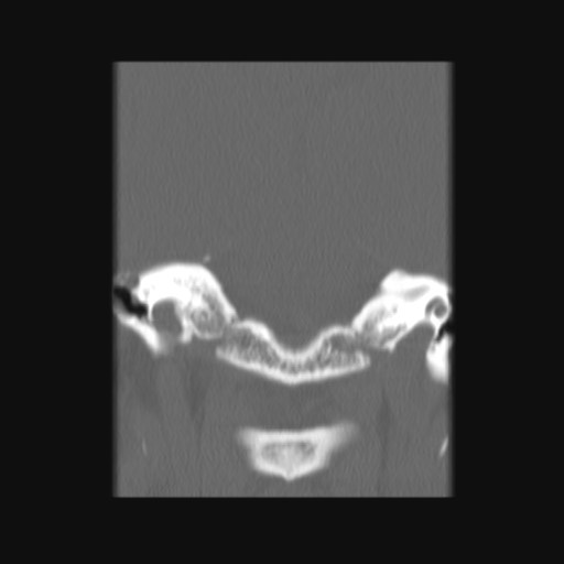 Normal sinus CT (annotated) (Radiopaedia 78917-91810 Coronal bone window 58).jpg