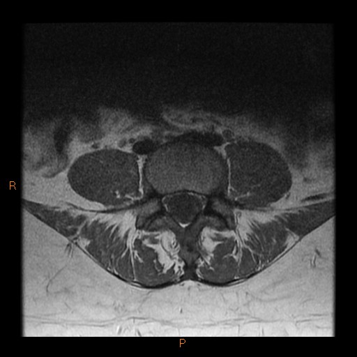 File:Normal spine MRI (Radiopaedia 77323-89408 Axial T1 17).jpg