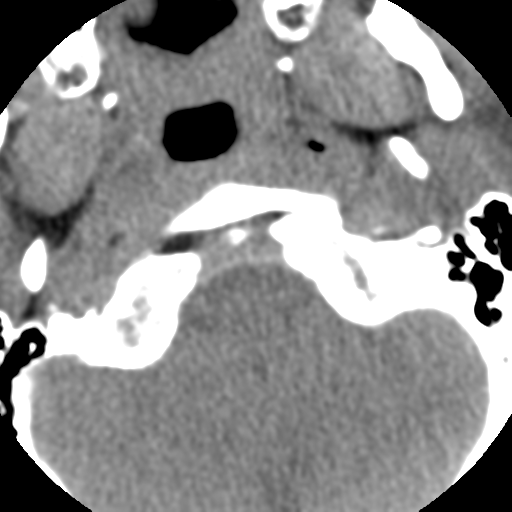 Normal trauma cervical spine (Radiopaedia 41017-43760 Axial non-contrast 9).png