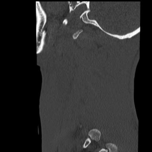 File:Normal trauma cervical spine (Radiopaedia 41017-43760 Sagittal bone window 46).png