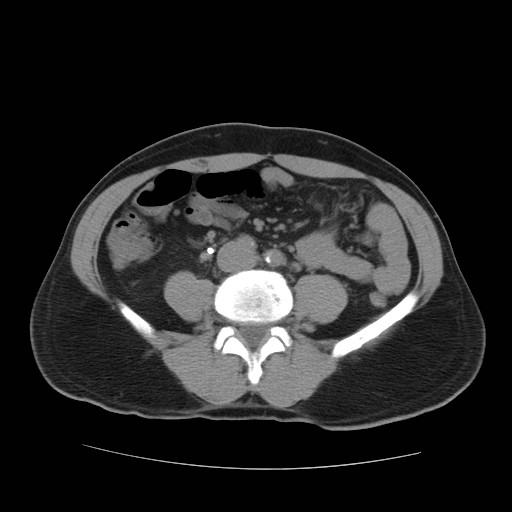 File:Obstructed kidney with perinephric urinoma (Radiopaedia 26889-27067 Axial non-contrast 26).jpg