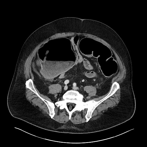 File:Obstructing sigmoid adenocarcinoma (Radiopaedia 58465-65619 A 115).jpg