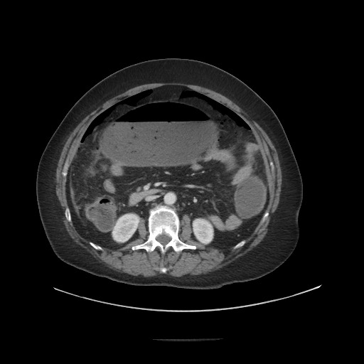Obstructive distal colonic adenocarcinoma causing cecal perforation (Radiopaedia 86830-102989 A 94).jpg