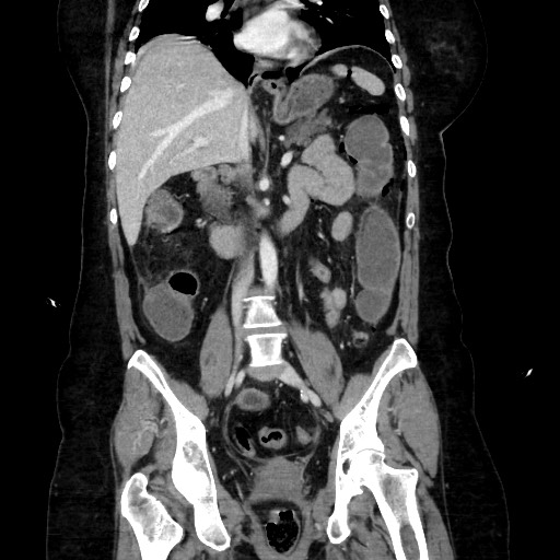 Obstructive distal colonic adenocarcinoma causing cecal perforation (Radiopaedia 86830-102989 C 104).jpg