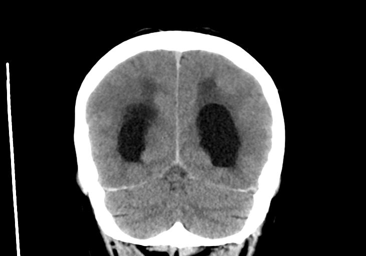 File:Obstructive hydrocephalus (Radiopaedia 30453-31119 Coronal non-contrast 31).jpg
