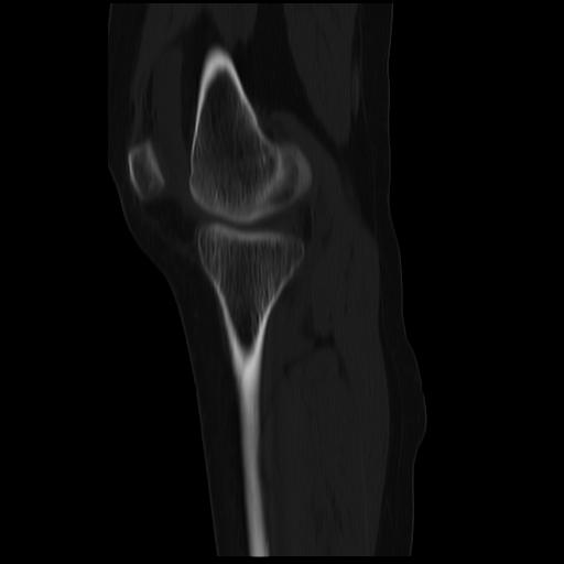 File:ACL avulsion fracture (Radiopaedia 33833-34994 Sagittal bone window 30).jpg