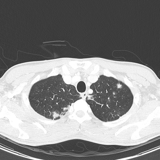 AIDS-related Kaposi sarcoma (Radiopaedia 85247-100811 Axial lung window 25).jpg