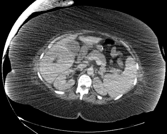 File:Abdominal abscess - pre and post percutaneous drainage (Radiopaedia 60209-67816 Axial 59).png