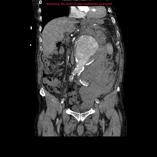 Abdominal aortic aneurysm- extremely large, ruptured (Radiopaedia 19882-19921 Coronal C+ arterial phase 45).jpg