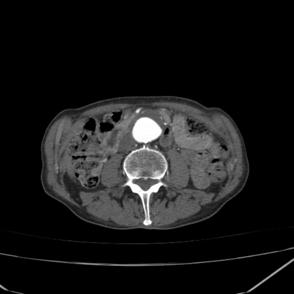Abdominal aortic aneurysm (Radiopaedia 23703-23856 Axial C+ arterial phase 42).jpg