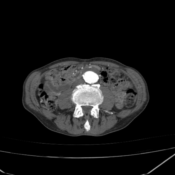 Abdominal aortic aneurysm (Radiopaedia 23703-23856 Axial C+ arterial phase 49).jpg