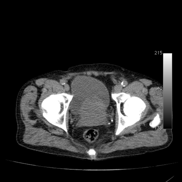 Abdominal aortic aneurysm (Radiopaedia 29248-29660 Axial non-contrast 54).jpg