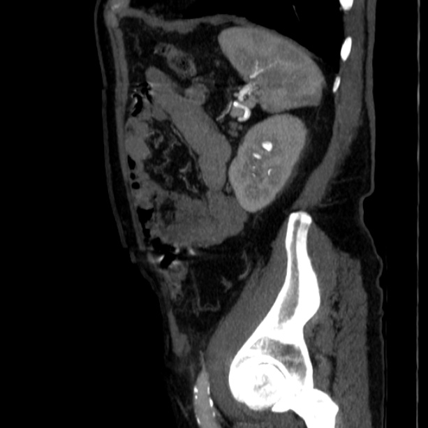 Abdominal aortic aneurysm (Radiopaedia 29248-29660 Sagittal C+ arterial phase 43).jpg