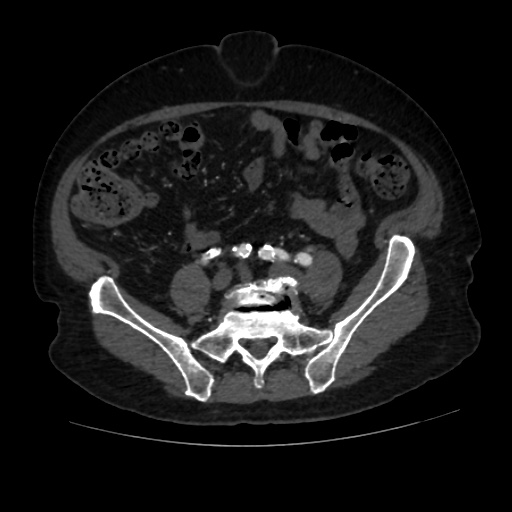 File:Abdominal aortic aneurysm (Radiopaedia 57318-64259 Axial C+ arterial phase 52).jpg
