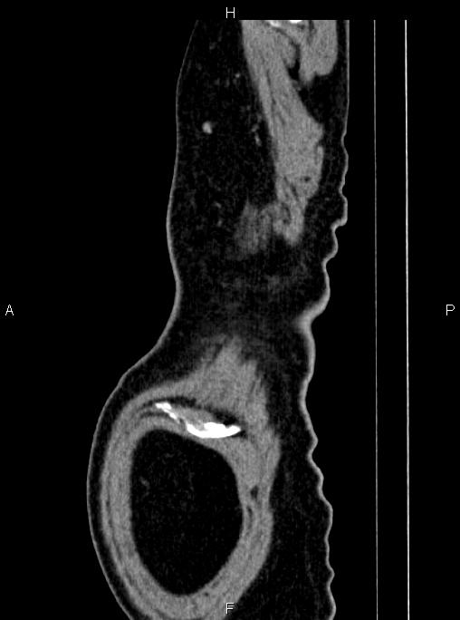 Abdominal aortic aneurysm (Radiopaedia 83094-97462 Sagittal renal cortical phase 122).jpg